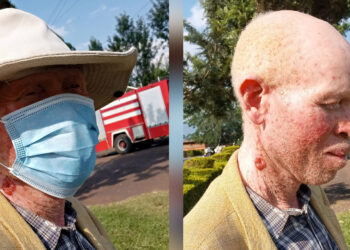 Kisoro: Albinos face stigma, Skin Cancer soars