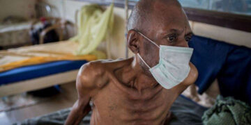 Kisoro Health Officials Raise Alarm over Rising Tuberculosis Cases, Warn Against Vaccine Misinformation